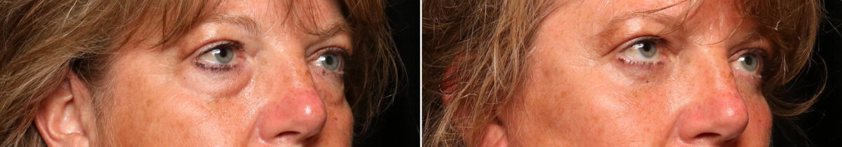 Blepharoplasty Before and After Photos in Cincinnati, OH, Patient 10489