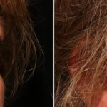 Blepharoplasty Before and After Photos in Cincinnati, OH, Patient 10489