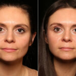 Fat Transfer Before and After Photos in Cincinnati, OH, Patient 10507