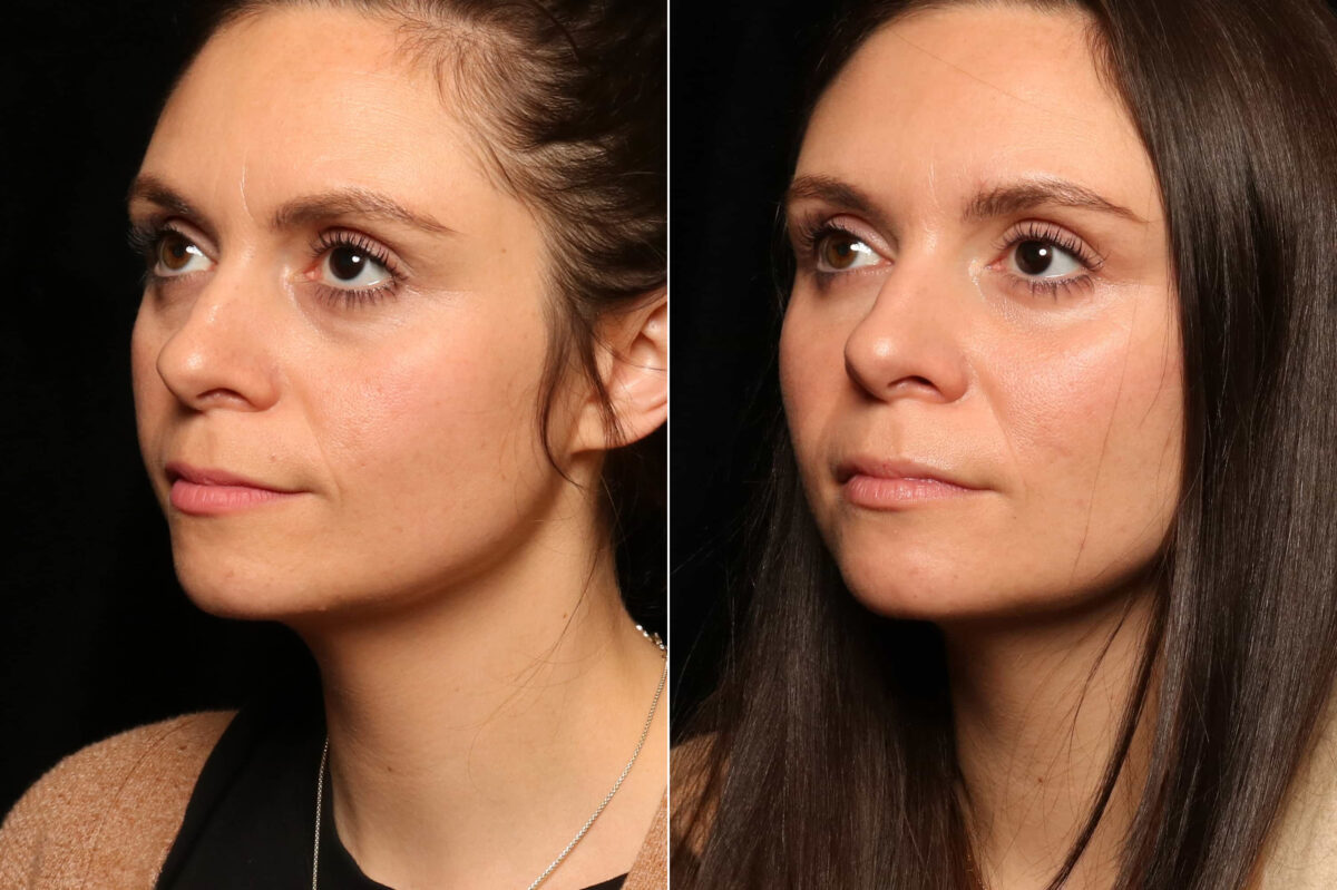 Fat Transfer Before and After Photos in Cincinnati, OH, Patient 10507
