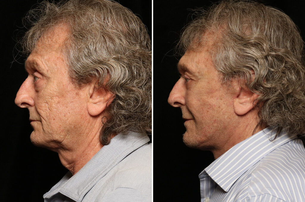 Facelift Results Before and After Photos Cincinnati, OH