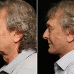 Male Plastic Surgery Before and After Photos in Cincinnati, OH, Patient 10705