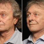 Male Plastic Surgery Before and After Photos in Cincinnati, OH, Patient 10705