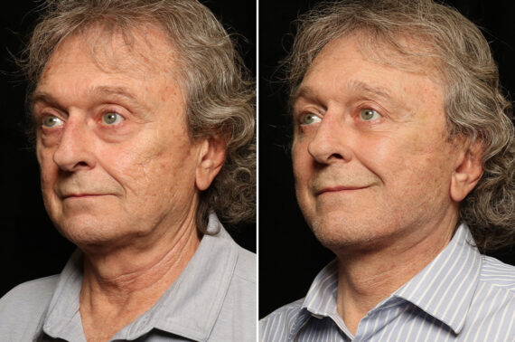 Minilift / Facelift Before and After Photos in Cincinnati, OH, Patient 10705