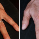 Fat Transfer Before and After Photos in Cincinnati, OH, Patient 10740