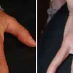 Fat Transfer Before and After Photos in Cincinnati, OH, Patient 10740