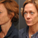 Blepharoplasty Before and After Photos in Cincinnati, OH, Patient 6993