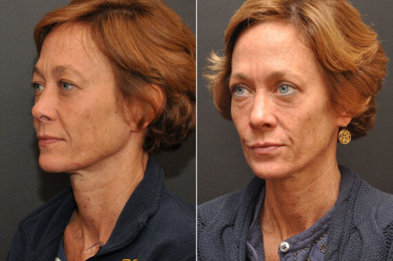 Blepharoplasty Before and After Photos in Cincinnati, OH, Patient 6993