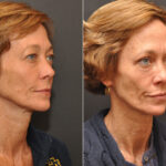 Blepharoplasty Before and After Photos in Cincinnati, OH, Patient 6993