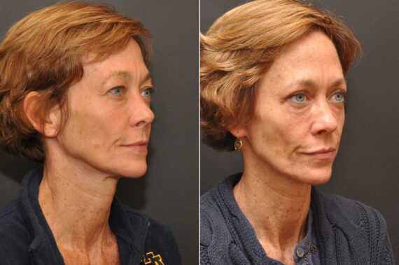 Blepharoplasty Before and After Photos in Cincinnati, OH, Patient 6993