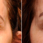Cosmetic Injectables Before and After Photos in Cincinnati, OH, Patient 9269