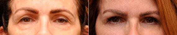 Cosmetic Injectables Before and After Photos in Cincinnati, OH, Patient 9269