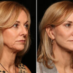 LuxeLift Before and After Photos in Cincinnati, OH, Patient 10893
