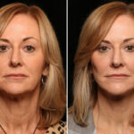 LuxeLift Before and After Photos in Cincinnati, OH, Patient 10893