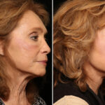 Lateral Neck Lift Before and After Photos in Cincinnati, OH, Patient 11926