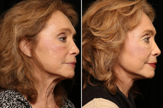 Lateral Neck Lift Before and After Photos in Cincinnati, OH, Patient 11926