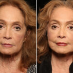Lateral Neck Lift Before and After Photos in Cincinnati, OH, Patient 11926