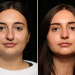 Rhinoplasty (Nose Reshaping) Before and After Photos in Cincinnati, OH, Patient 11936