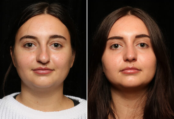 Rhinoplasty (Nose Reshaping) Before and After Photos in Cincinnati, OH, Patient 11936