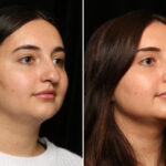 Rhinoplasty (Nose Reshaping) Before and After Photos in Cincinnati, OH, Patient 11936