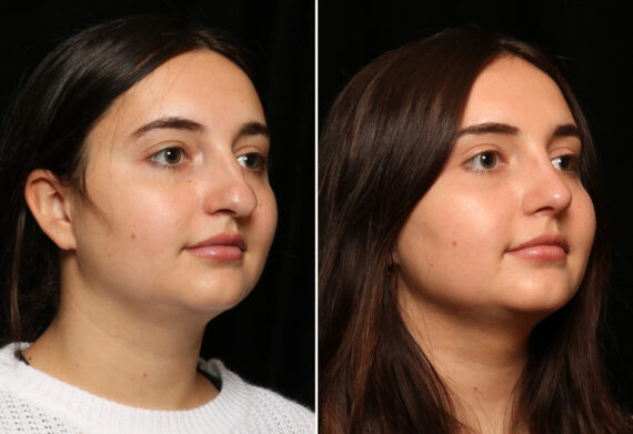 Rhinoplasty (Nose Reshaping) Before and After Photos in Cincinnati, OH, Patient 11936