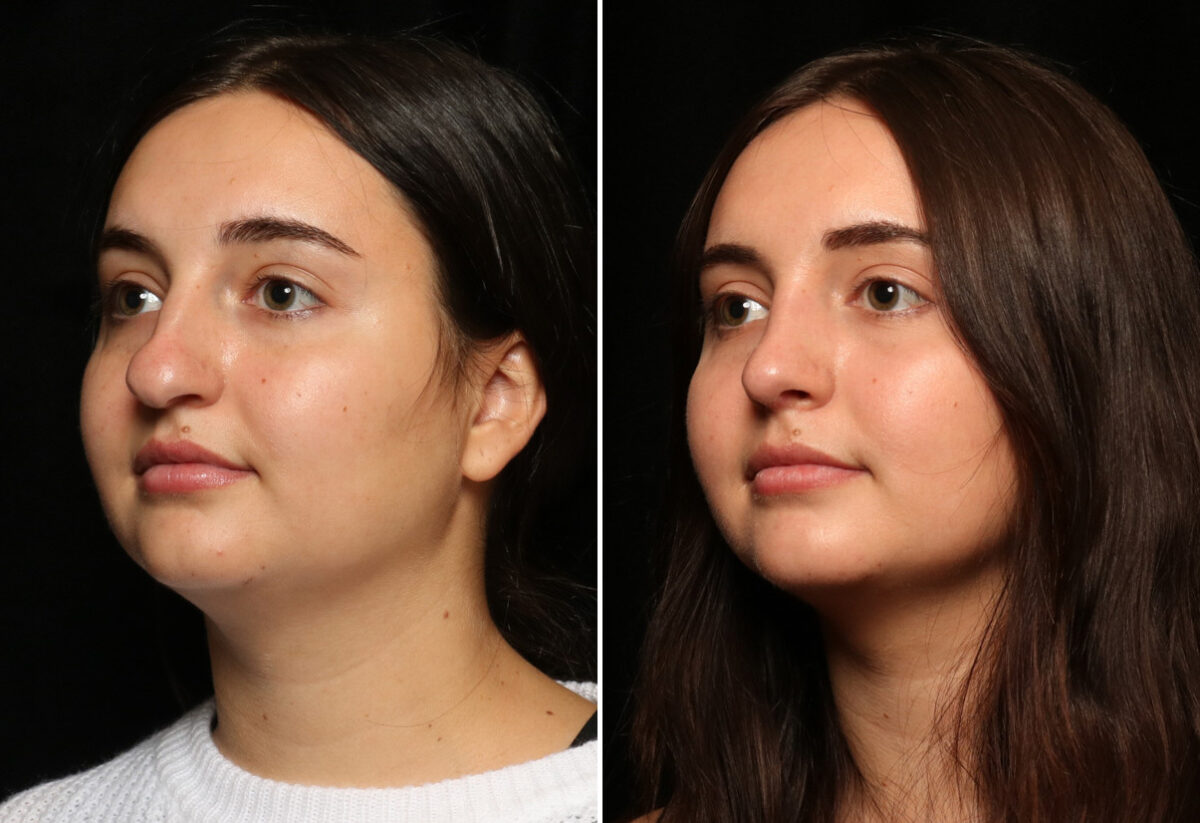 Rhinoplasty (Nose Reshaping) Before and After Photos in Cincinnati, OH, Patient 11936