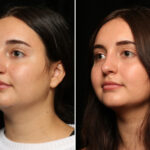 Rhinoplasty (Nose Reshaping) Before and After Photos in Cincinnati, OH, Patient 11936