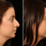 Rhinoplasty (Nose Reshaping) Before and After Photos in Cincinnati, OH, Patient 11948