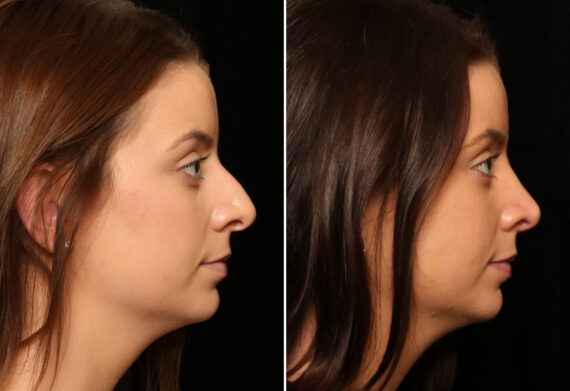 Rhinoplasty (Nose Reshaping) Before and After Photos in Cincinnati, OH, Patient 11948