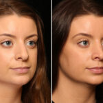 Rhinoplasty (Nose Reshaping) Before and After Photos in Cincinnati, OH, Patient 11948