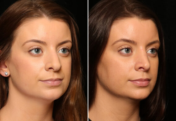 Rhinoplasty (Nose Reshaping) Before and After Photos in Cincinnati, OH, Patient 11948