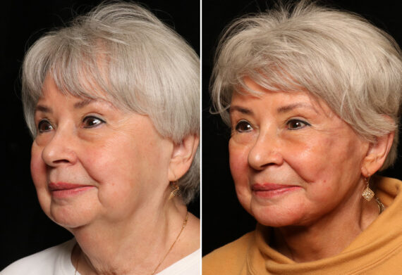 LuxeLift Before and After Photos in Cincinnati, OH, Patient 11955