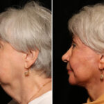 LuxeLift Before and After Photos in Cincinnati, OH, Patient 11955