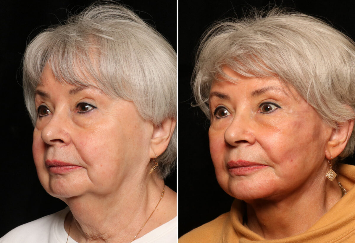LuxeLift Before and After Photos in Cincinnati, OH, Patient 11955