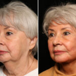 LuxeLift Before and After Photos in Cincinnati, OH, Patient 11955