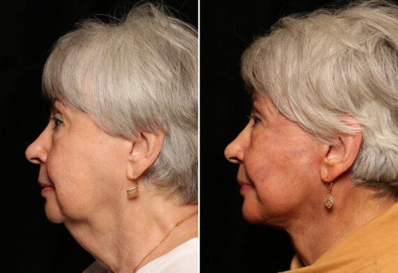 LuxeLift Before and After Photos in Cincinnati, OH, Patient 11955