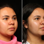 Facial Liposuction Before and After Photos in Cincinnati, OH, Patient 11965