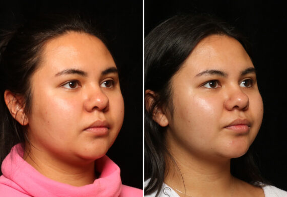 Facial Liposuction Before and After Photos in Cincinnati, OH, Patient 11965