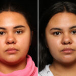 Facial Liposuction Before and After Photos in Cincinnati, OH, Patient 11965