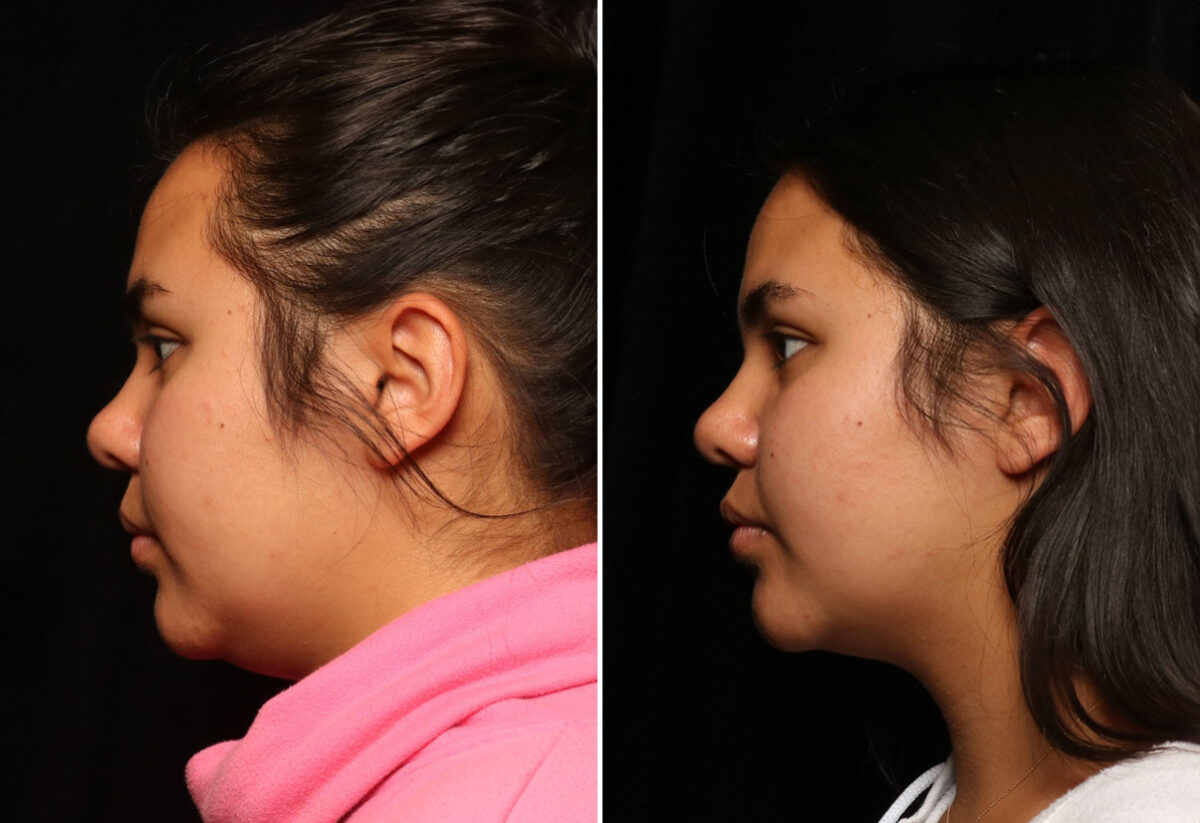 Facial Liposuction Before and After Photos in Cincinnati, OH, Patient 11965