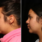 Facial Liposuction Before and After Photos in Cincinnati, OH, Patient 11965