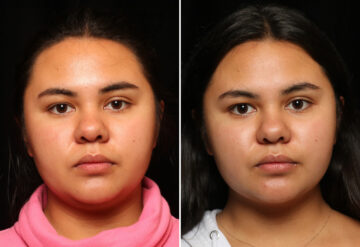 Facial Liposuction Before and After Photos in Cincinnati, OH, Patient 11965