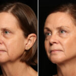 LuxeLift Before and After Photos in Cincinnati, OH, Patient 12072