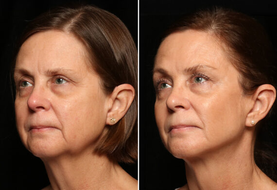 LuxeLift Before and After Photos in Cincinnati, OH, Patient 12072