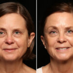 LuxeLift Before and After Photos in Cincinnati, OH, Patient 12072
