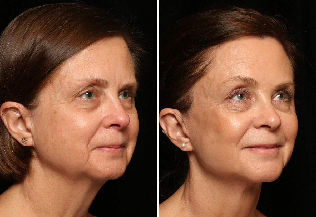 LuxeLift Before and After Photos in Cincinnati, OH, Patient 12072