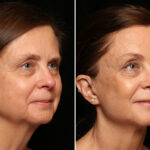 LuxeLift Before and After Photos in Cincinnati, OH, Patient 12072
