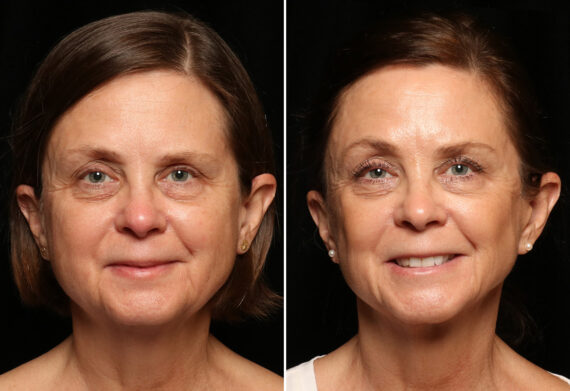 LuxeLift Before and After Photos in Cincinnati, OH, Patient 12072