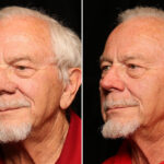 Reconstructive / Other Before and After Photos in Cincinnati, OH, Patient 12089