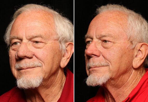 Reconstructive / Other Before and After Photos in Cincinnati, OH